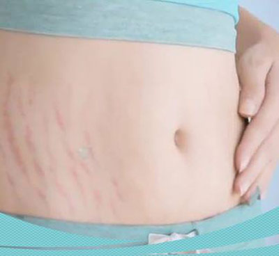 Vấn đề da thường gặp khi mang thai