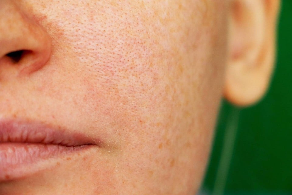 Cách chăm sóc da mặt sần sùi lỗ chân lông