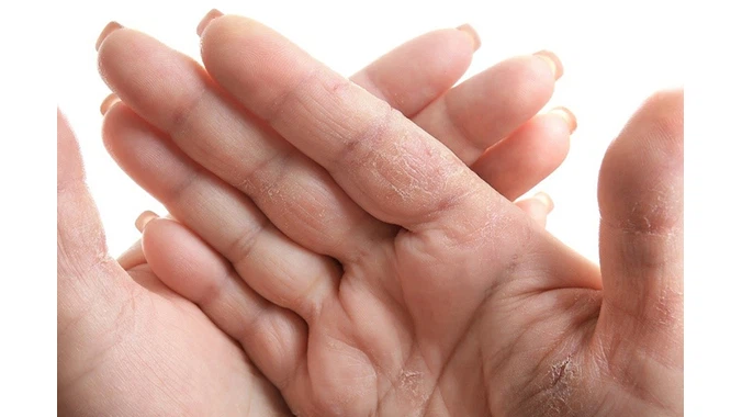 Cách đối phó với da tay khô nứt nẻ