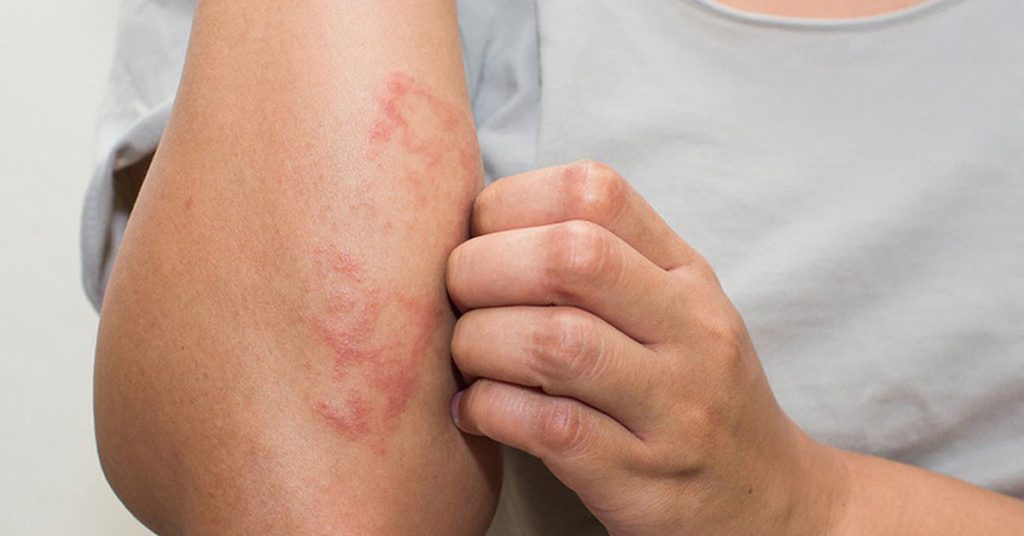 Bệnh Eczema có chữa khỏi hoàn toàn được không?