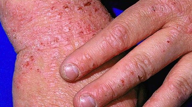Bệnh Eczema và cách điều trị hiệu quả