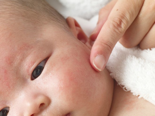 Viêm da cơ địa ở trẻ em và trẻ sơ sinh